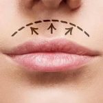 Lip Lift — Dudak Kaldırma