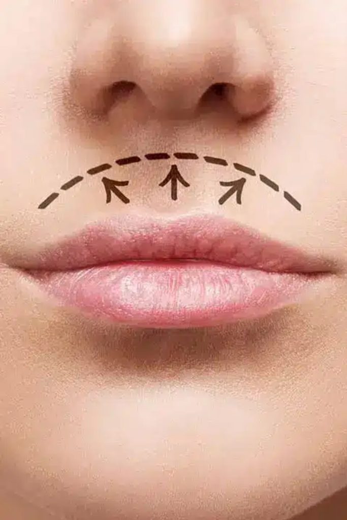 Lip Lift – Dudak Kaldırma