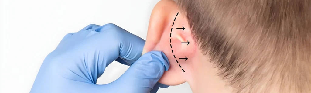 Kepçe Kulak Ameliyatı (Otoplasti) Rehberi
